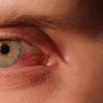 راه‌های درمان قرمزی و ورم چشم و آلرژی‌های مربوط به چشم