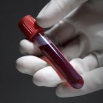 راه‌های درمان و کاهش کلسترول خون بالا